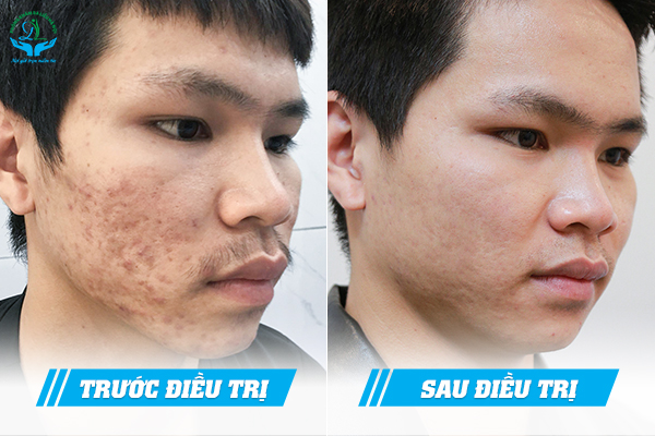 Trước & Sau