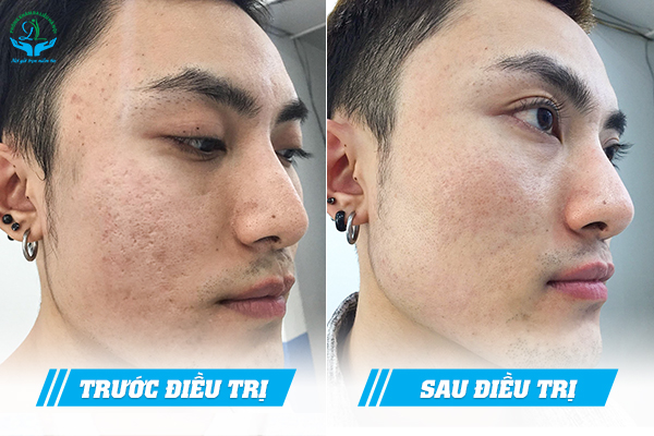 Trước & Sau