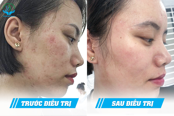 Trước & Sau