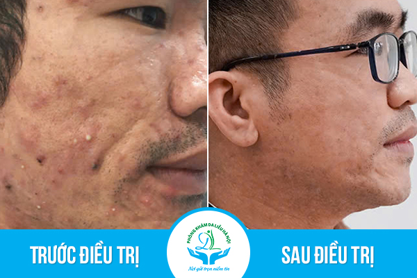 Trước & Sau