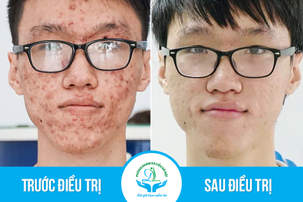 Trước & Sau