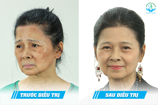 Trước & Sau