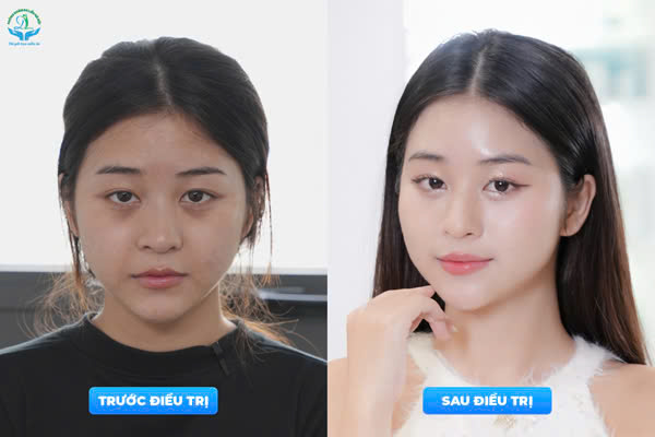 Trước & Sau