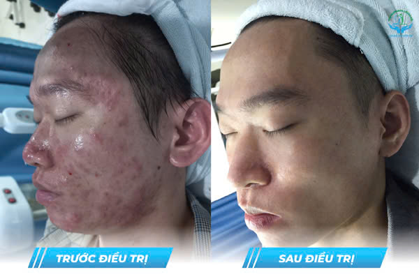 Trước & Sau