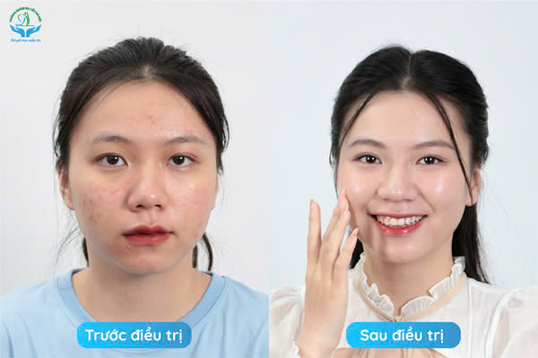 Trước & Sau