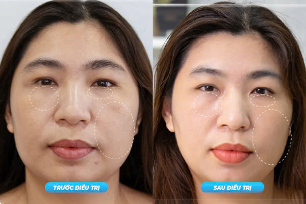 Trước & Sau