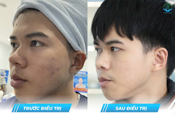 Trước & Sau