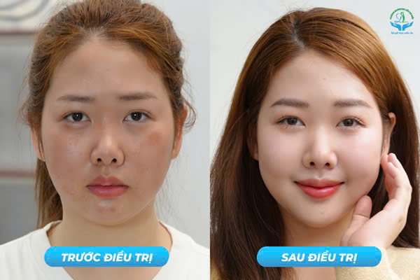 Trước & Sau